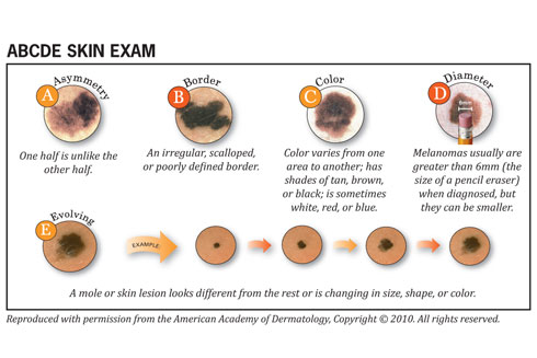 The ABCDE steps for Skin Cancer Self Exam